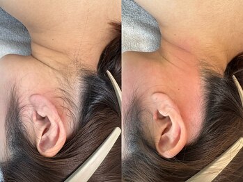 ヒーリングハーツ(Healing Hearts)/もみあげ・うなじシュガーリング