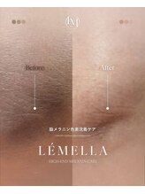 アリム(alim)/ルメラ脇　ビフォーアフター