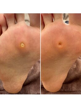 なかやまネイルクリニック/タコ・魚の目