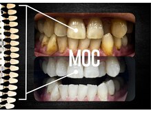 モック 麻布十番(MOC)/ホワイトニング/麻布十番/六本木