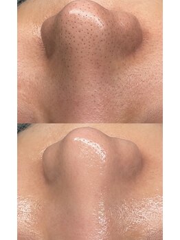 ピクシー(pixie)の写真/大人気の毛穴トックスフェイシャル！