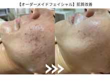 グロウ バイ フェイシャルデザイン アンド アイ(GROW)/肌質改善