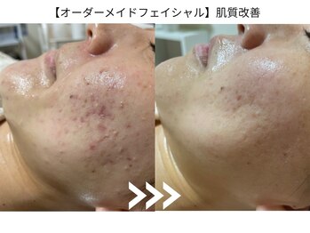 グロウ バイ フェイシャルデザイン アンド アイ(GROW)/肌質改善