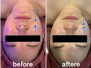 エステティックジュネス(JEUNESSE)の写真/【40代50代女性向け人気NO1】 次世代リフトケア
サーマルフラクショナル全顔+美容液導入