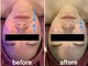 エステティックジュネス(JEUNESSE)の写真/【40代50代女性向け人気NO1】 次世代リフトケア
サーマルフラクショナル全顔+美容液導入