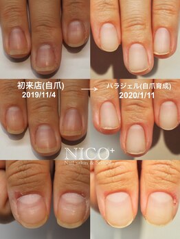 ニコプラス(NICO+)/パラジェルクリア補強