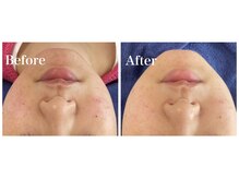 ピュア 川越店/ニキビ徹底ケアコース