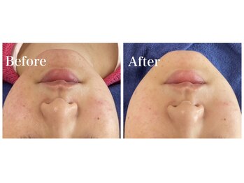 ピュア 川越店/ニキビ徹底ケアコース