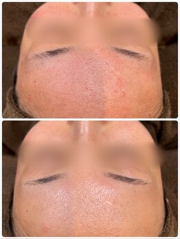 アンジェロ/【ニキビケア】肌育プログラム