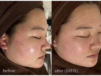 アイル 高槻店(iru)/剥けるハーブピーリング7回目