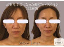 小顔職人/小顔ビフォーアフター/30代