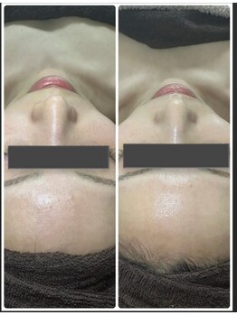 セルヴィノバ(CELL VI NOVA)の写真/今までにない感動ツヤ肌仕上げ◎剥離なして圧倒的な肌質改善結果!1年以上何をしても変わらなかったあなたへ