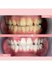【医療提携ジェル付】4～5トーンUP◎ハイパワーホワイトニング15分照射