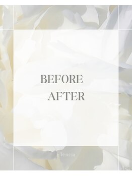 エレンシア(E'lencia)/施術効果（Before/After）