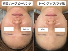 ウィンク 勝どき(wink)の雰囲気（話題沸騰中★ハーブピーリング！剥離なしで翌日からメイクOK！）