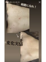 エミルカ 自由が丘店(EMILUCA)/背中症例