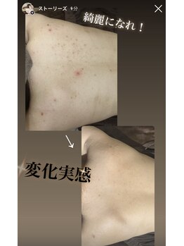 エミルカ 自由が丘店(EMILUCA)/背中症例