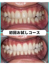 ホワイトニングビューティー 吉祥寺店/ホワイトニング　初来店