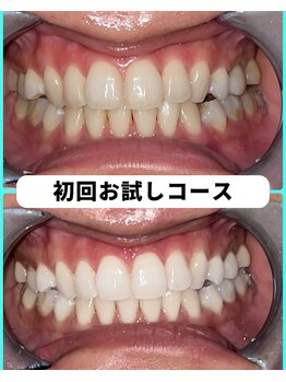 ホワイトニングビューティー 吉祥寺店/ホワイトニング 初来店