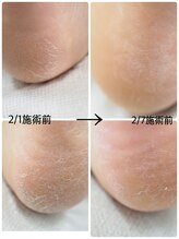 ネイル キャンバス シルヴァ(Nail Canvas Silva.)/角質ケアの経過