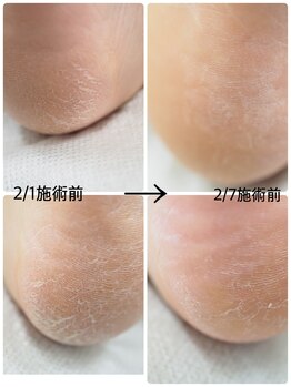 ネイル キャンバス シルヴァ(Nail Canvas Silva.)/角質ケアの経過