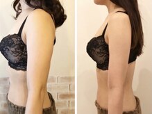 リール 新宿店(RIRE)/ 20代後半　バストアップ症例