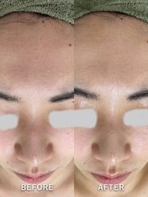 サロンドジェシカ(salon de Jessica)/毛穴洗浄フェイシャル