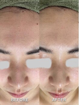 サロンドジェシカ(salon de Jessica)/毛穴洗浄フェイシャル