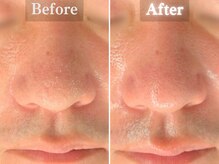 ボーンオム(Born Homme)/毛穴洗浄＋美容液導入：40代男性