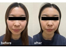 まえかわ鍼灸整骨院/美容鍼ビフォーアフター