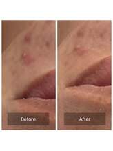 ビジュープラス 筑西下館店(Bijou+)/【20代お悩み】ニキビ／初回