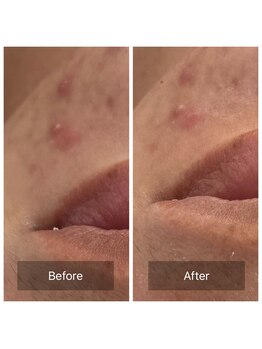 ビジュープラス 筑西下館店(Bijou+)/【20代お悩み】ニキビ/初回