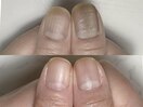 凸凹爪は半年で卒業！自爪育成