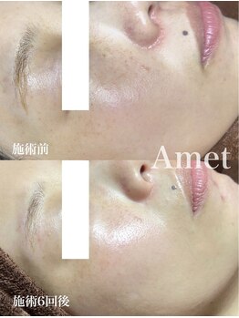 アメット(Amet)/ハーブピーリング ＋ シミケア