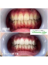 ホワイトニングサロン 名古屋駅店/【ホワイトニング施術例】