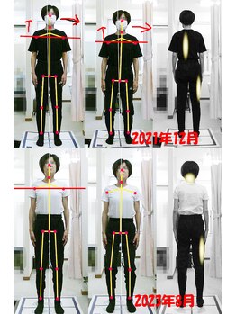 姫路なごみ整体院 なごみ鍼灸院/改善例（お尻と座骨の痛み）