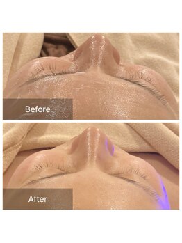 トータルビューティ リライフ(Total beauty Relife)/光フェイシャル人気です★