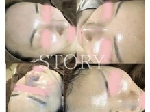 ストーリー 岐阜店(STORY)/ハーブピーリング専門店STORY