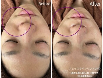 ミラ 中央林間(mira)/小顔　毛穴　ホワイトニング