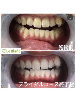 ルブラン 奈良店(Le Blanc)/3週間で白い歯を！