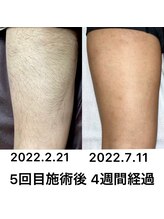 アシヤ髭ラボ(ASHIYA 髭 LABO)/足脱毛ビフォーアフター