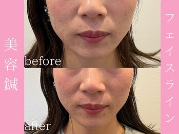 ビープラス(BEE PLUS)/フェイスライン、エラ