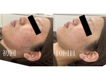 チャマ 高知店(CHAMA)/20代　ララピール　ニキビ改善