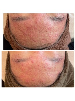 ウェリナベル(WelinaBelle)/無添加国産ハーブピーリング