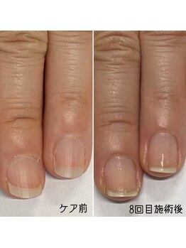 ネイルズ アヴァンティ(Nails Avanti)/自爪育成ケア3ヶ月コース