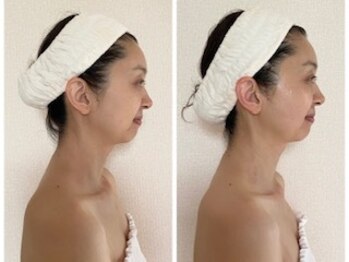 ル シエル(Le Ciel)/40代/施術横顔/左before右after