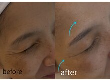 ルーム701(room701)/深シワ　真皮の老化　ヘッドスパ