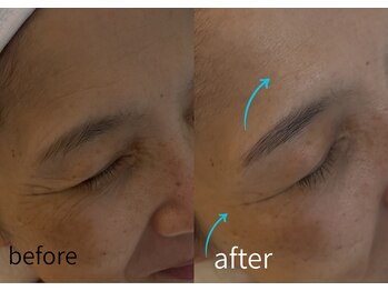 ルーム701(room701)/深シワ 真皮の老化 ヘッドスパ