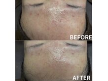 ライリー(Rairy)の雰囲気（【ニキビ】天然国産×ヒト幹オーダーメイドハーブピーリング）