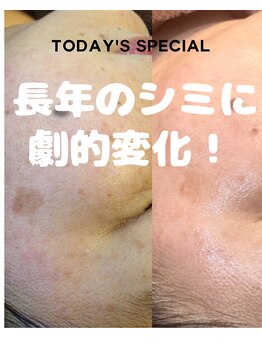 小さなおうちサロン こぐまの寝床の写真/美容通も納得！本気のシミ改善へ☆肌負担なし画期的なコース◎20個10890円
